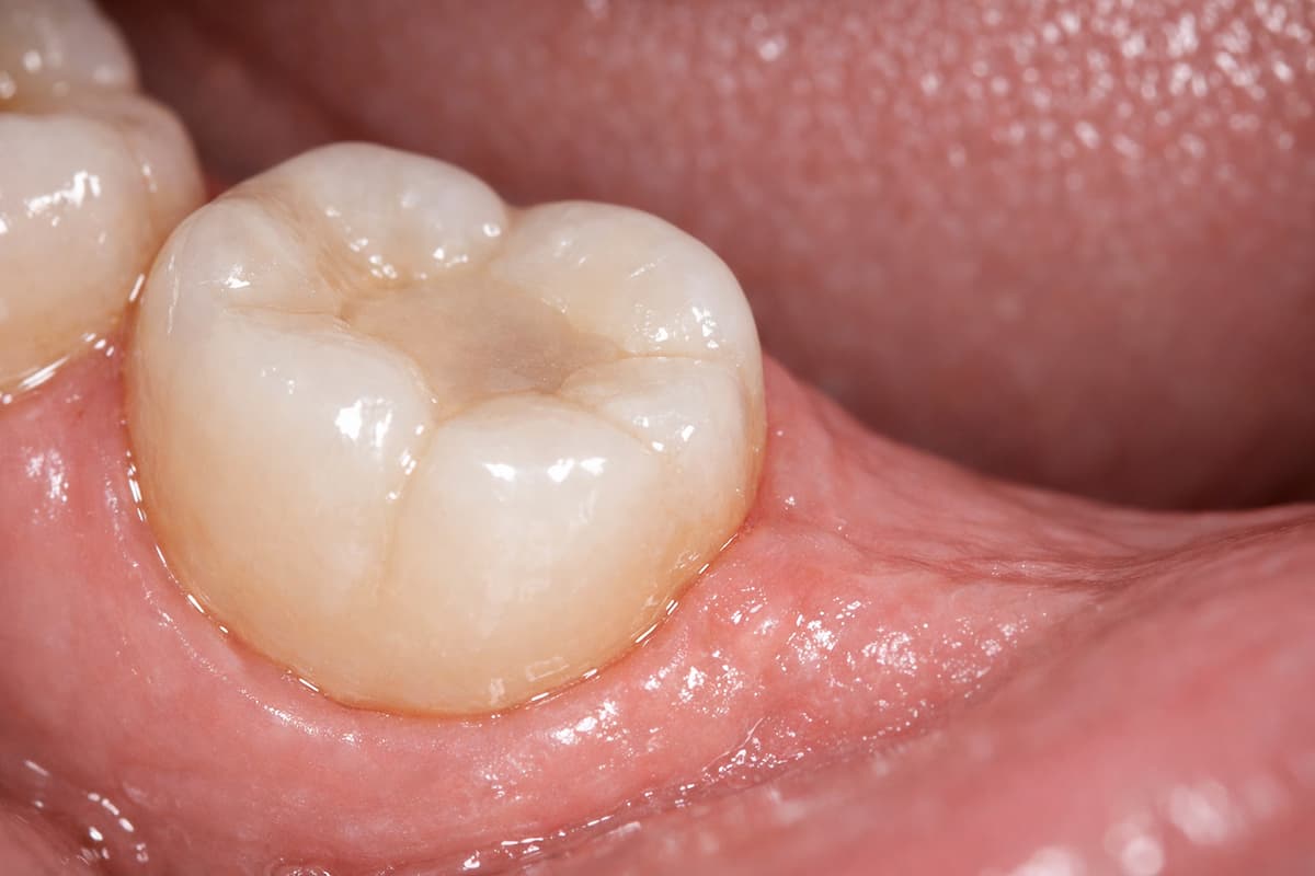Endodoncia Trenčín